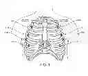 Fig. 02 - Methods of treating a cardiac arrhythmia by thoracoscopic production of a Cox maze III lesion set