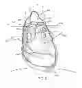 Fig. 03 - Methods of treating a cardiac arrhythmia by thoracoscopic production of a Cox maze III lesion set