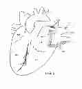 Fig. 04 - Methods of treating a cardiac arrhythmia by thoracoscopic production of a Cox maze III lesion set