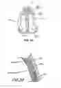 Fig. 03 - Methods and devices to treat nasal airways