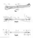Fig. 02 - Intramedullary nail having self-retaining compression slot