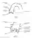 Fig. 02 - Fracturing calcifications in heart valves