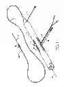 Fig. 02 - DEVICES, SYSTEMS AND METHODS FOR A GUIDE WIRE LOADER