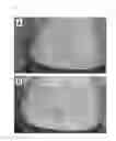 Fig. 07 - Skin Patch Instrument For Treating Pain