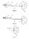 Fig. 08 - Intervertebral disc annulus repair system and bone anchor delivery tool