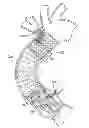 Fig. 01 - Heart valve and endovascular graft components and method for delivery