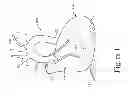 Fig. 02 - Heart valve and endovascular graft components and method for delivery