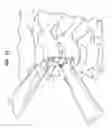 Fig. 35 - Intervertebral disc and insertion methods therefor