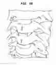 Fig. 43 - Intervertebral disc and insertion methods therefor
