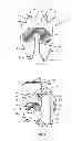 Fig. 02 - Resilient interpositional arthroplasty device