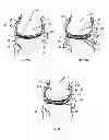 Fig. 07 - Resilient interpositional arthroplasty device