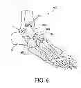 Fig. 09 - Bone prosthesis for maintaining joint operation in complex joints