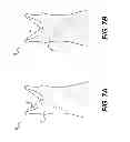 Fig. 06 - Reversible compression garments and methods of assembling and using same