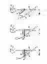 Fig. 04 - Foldable walking stabilizer device