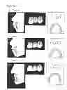 Fig. 15 - ARTIFICIAL TOOTH, A JIG FOR ARRANGING THE SAME, AN ARRANGEMENT METHOD OF THE SAME AND A DENTURE