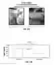 Fig. 35 - Chemotherapeutic compositions and methods for treating human gliomas