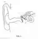 Fig. 02 - Middle ear implant sensor