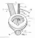 Fig. 02 - Laryngeal mask for use with an endoscope