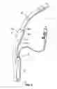 Fig. 10 - Laryngeal mask for use with an endoscope
