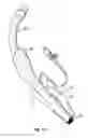 Fig. 12 - Laryngeal mask for use with an endoscope
