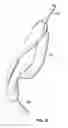 Fig. 25 - Laryngeal mask for use with an endoscope