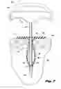 Fig. 04 - Devices for and methods of performing minimally-invasive surgical procedures through a single incision