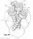 Fig. 32 - Devices for and methods of performing minimally-invasive surgical procedures through a single incision