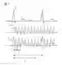 Fig. 02 - Method and EKG trigger device for correcting an EKG signal in magnetic resonance image acquisition