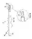 Fig. 03 - DEVICE AND PROCESS TO CONFIRM OCCLUSION OF THE FALLOPIAN TUBE