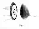 Fig. 10 - ULTRASONIC IMAGE-GUIDED TISSUE-DAMAGING PROCEDURE