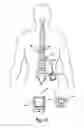 Fig. 04 - Anchor sleeve for implantable lead