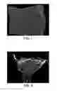 Fig. 08 - Wound dressing for use in vacuum therapy