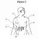 Fig. 02 - Methods for renal nerve blocking
