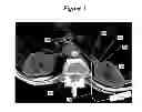 Fig. 04 - Methods for renal nerve blocking
