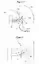 Fig. 06 - Methods for renal nerve blocking