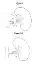 Fig. 08 - Methods for renal nerve blocking