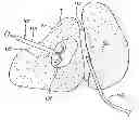 Fig. 01 - Radio frequency ablation cooling shield