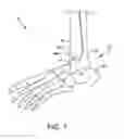 Fig. 02 - Orthopedic surgical guide