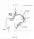 Fig. 07 - Apparatus and method for distracting the hip joint