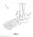 Fig. 02 - Orthopedic surgical guide