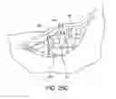 Fig. 22 - Orthopedic surgical guide