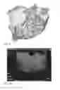 Fig. 10 - System and method for pelvic floor repair
