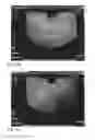 Fig. 11 - System and method for pelvic floor repair