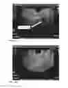 Fig. 12 - System and method for pelvic floor repair
