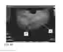 Fig. 13 - System and method for pelvic floor repair