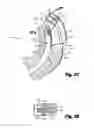 Fig. 06 - Suturing instrument and method for uterine preservation