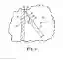 Fig. 04 - Tissue stabilization and repair device