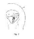Fig. 06 - Suture anchor device, kit, and method