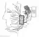 Fig. 01 - System and method for facial nerve stimulation