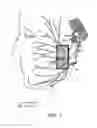 Fig. 08 - System and method for facial nerve stimulation